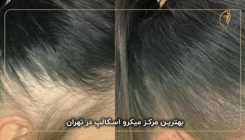مرکز اسپرت بیوتی سنتر : پیشرو در ارائه خدمات میکرو اسکالپ حرفه ای در تهران