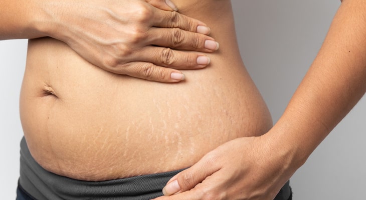 پوست کرم ترک پوستی برای ترک های ناشی از جراحی