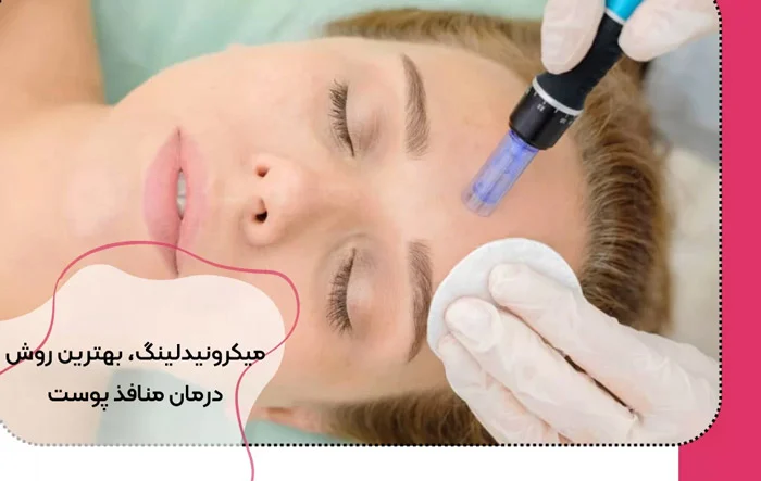 میکرونیدلینگ (درمان جای جوش،لک های پوستی،منافذ باز)