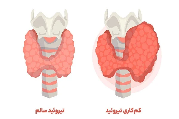 کدام میوه‌ها برای کم‌کاری تیروئید مفید هستند؟